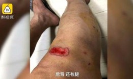 被烫伤敢吃凉瓜吗图片,敢挑战凉瓜的清凉滋味吗？